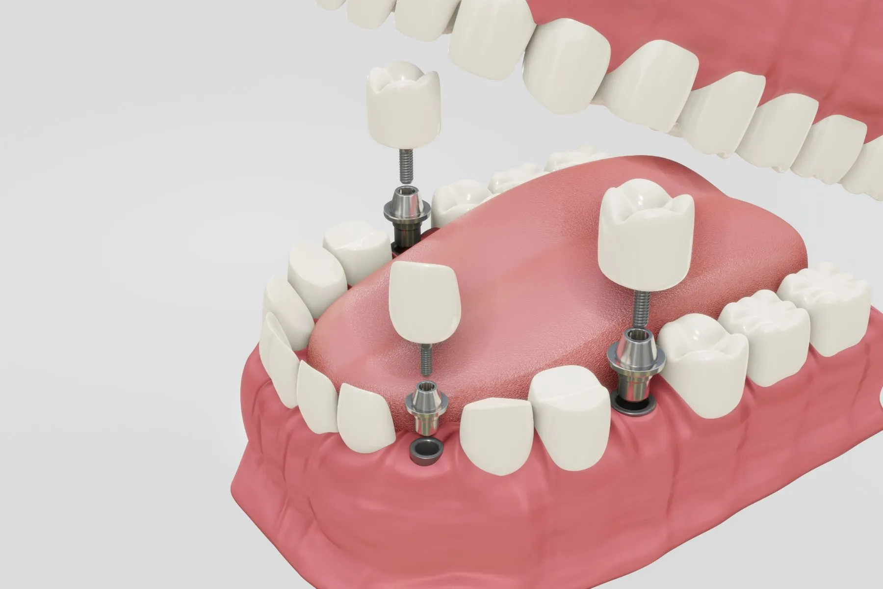 dental implants glossary